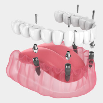 All on X Dental Implants