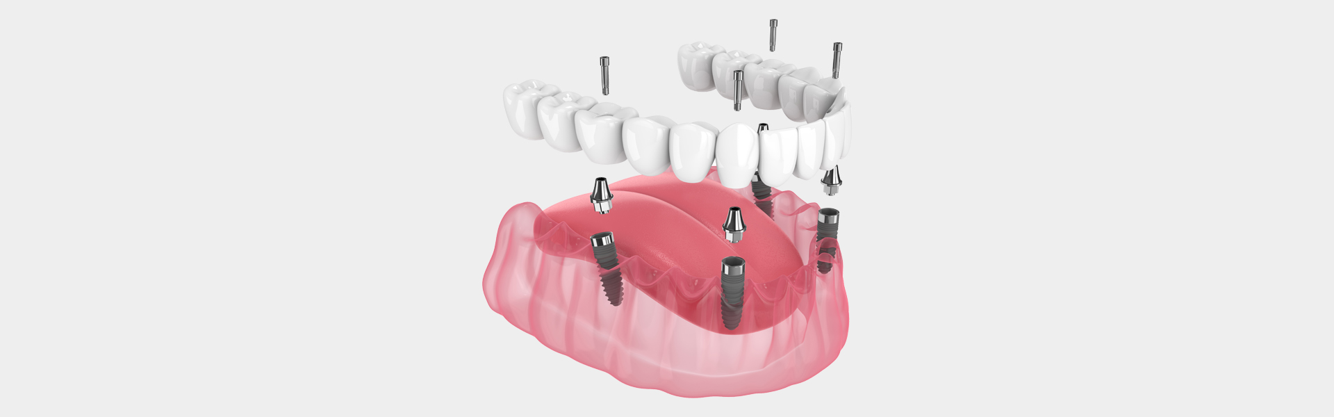 All on X Dental Implants