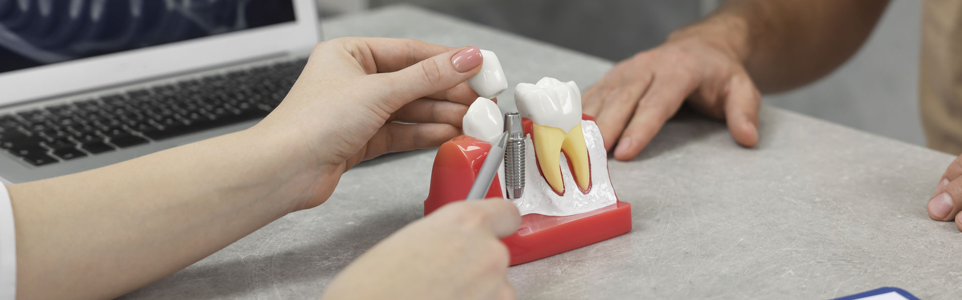 Can your body reject your dental implant